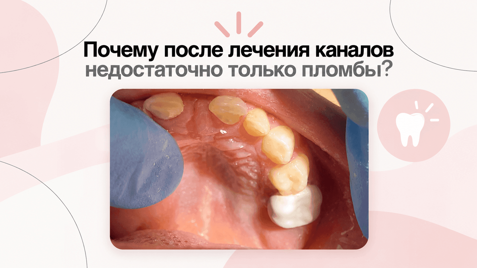 CASE | A CROWN ON TOOTH 55 AFTER PULP TREATMENT